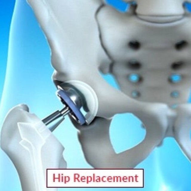 https://www.edhacare.com/treatments/orthopedic/hip-replacement