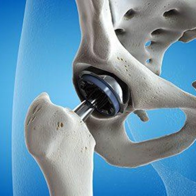 Hip Replacement Surgery: A New Beginning for Joint Health, In Yobe, Nigeria