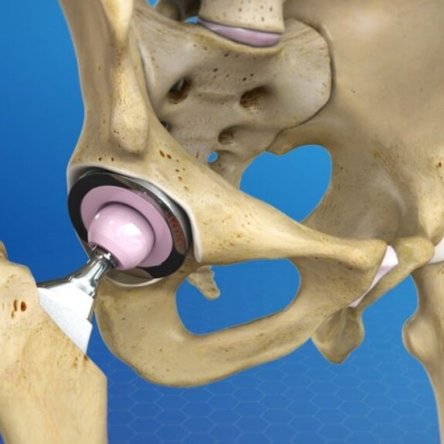 Hip Replacement Surgery: Your Path to an Active, Pain-Free Life, In Kenya